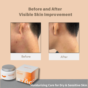 Crema Hidratante para Eccema y Piel Problemática, Venta Caliente, Crema de Hidratación Profunda para Piel Seca y Sensible, Suministro Directo de Fábrica - Product Image 4