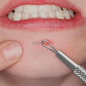 Professional Stainless Steel <b>Blackhead</b> & Whitehead Remover Pimple <b>Extractor</b> Kit-Reusable & Waterproof - Product Image 5