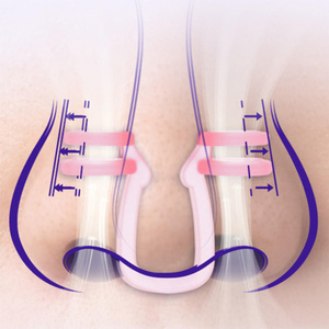 [Dream Air] Dilatador Nasal NOSK con Certificación CE, Talla Única, Alivio de Ronquidos, Clip Nasal Anti-Ronquidos para Mejor Flujo de Aire, Cómodo - Product Image 5