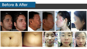 جهاز ليزر CO2 محمول عالي الجودة من ADSS مع تقنية الترددات الراديوية الجزئية طراز FG900-B - Product Image 6