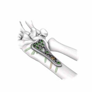 Placa de Bloqueo Volar para Radio Distal de 2.4mm, Implante de Titanio Reutilizable para Fijación de Fracturas Ortopédicas - Product Image 4