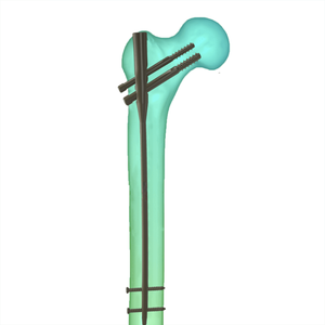 Instrumentos Ortopédicos de Acero Inoxidable para Clavo Femoral Proximal, Manuales, Reutilizables, Autoclavables, con Certificación CE - Product Image 3