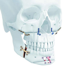 Système de fixation maxillo-faciale en maille de titane pour implant neurochirurgical, plaque de verrouillage et vis, par Mahfooz Instruments - Product Image 1