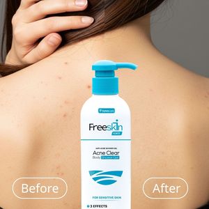 Gel Douche Corps Traitant l'Acné Formule Douce Forte pour le Dos et la Poitrine, Sûr pour Tous Types de Peau - Product Image 1