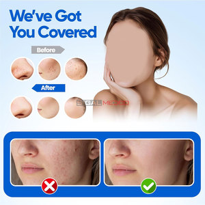 Extractor de Puntos Negros, Kit de 4 Piezas de Acero Inoxidable para Eliminar Granos, Acné y Puntos Blancos, Herramienta Reutilizable para Limpiar Poros Faciales y Nasales - Product Image 5