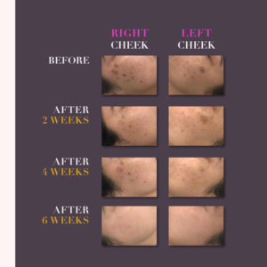 White Peel 3 Tipo A.H.A Ácido de almendras Leche Ácido de caña de azúcar y Ácido Kójico para eliminar manchas oscuras Blanqueamiento DE LA PIEL Suero Peeling - Product Image 2