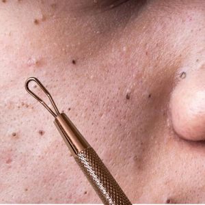 5 inch High Carbon Steel Face Comedone <b>Extractor</b> Tool | Professional Double-Ended Acne & <b>Blackhead</b> Remover - Product Image 6
