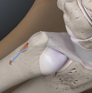 Gabarit de réparation de tunnel ulnaire TFCC Dispositif d'ancrage sans nœud de reconstruction de ligament radioulnaire pour l'approvisionnement en soins de santé du poignet de la main - Product Image 3