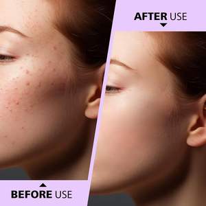 Extractor de Puntos Negros y Espinillas 2 en 1 Profesional UBI con Limpiador de Poros para Eliminar Comedones de la Cara y la Nariz - Product Image 5