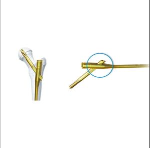 Clavo Intramedular Femoral Proximal PFNA de Acero Inoxidable Gama Nails, Manual, Alta Calidad, 1 Año de Garantía, Instrumentos - Product Image 2