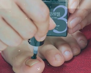 Kit de soin des ongles en gel pour ongles incarnés, application facile, traitement réparateur, gel coréen - Product Image 1