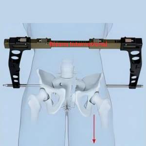 BISONS Instrumento de Fijación Externa con Abrazadera en C Pélvica Manual de Acero Inoxidable para Estabilización Pélvica de Emergencia - Product Image 5