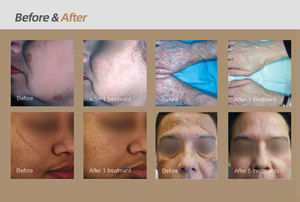 เครื่องเลเซอร์พิโคเซคันด์ ADSS ยอดนิย<span class=keywords><strong>ม</strong></span> เครื่องเลเซอร์ Nd Yag <span class=keywords><strong>Pico</strong></span> ลด<span class=keywords><strong>ราคา</strong></span>สุดคุ้<span class=keywords><strong>ม</strong></span> - Product Image 6