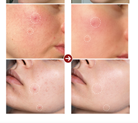 Parches Reusoul de Colágeno Hidrocoloide para Imperfecciones, AC Cica Spot Cover, Sin Fragancia, Forma de Corazón, 41 Parches, Veganos, Para Todo Tipo de Piel