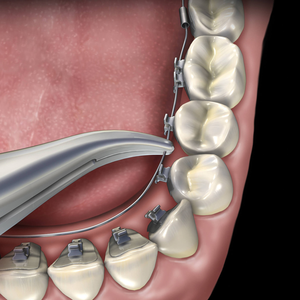 Lingual Weingart Pliers Professional Orthodontic <b>Tool</b> <b>Safe</b> Effective Dental Appliance Instrument High Quality Durable Precision - Product Image 1