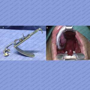 Retractor de Laringofaringoscopio con Certificación CE FK-WO, Endoscopio Manual para Cirugía Transoral, Alta Calidad, Salaar Industry - Product Image 2