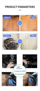 Appareil de refroidissement cutané avancé à air froid pour soulagement de la douleur, traitement au laser, élimination des tatouages, usage en salon - Product Image 4