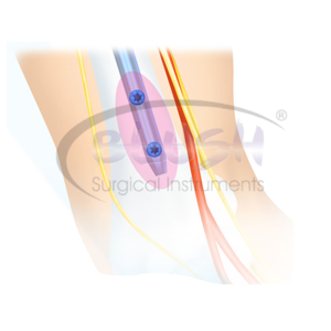 Clavo Intramedular Ortopédico Multibloqueo Interconectable para Húmero, Implantes y Materiales de Intervención de Blush Surgical - Product Image 3