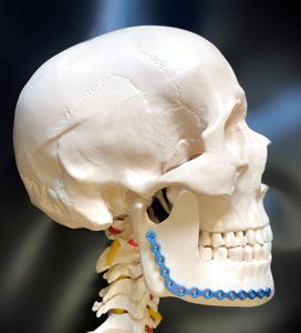 Placa Maxilofacial Ortopédica de Titanio de Grado Médico en Forma de L para Fijación Mandibular, Implante Quirúrgico Ortopédico - Product Image 5