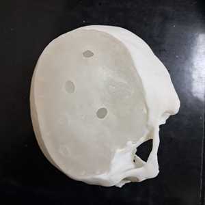 PMMA วัสดุฝังในกะโหลกศีรษะเฉพาะบุคคล - Product Image 3