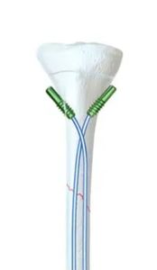 Clavo Intramedular Ortopédico de Aleación de Titanio para Niños, Clavo Elástico Femoral Interconectable de Surgiright Instrument - Product Image 2