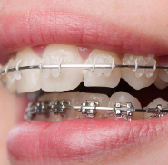 Hydropulseur dentaire sans fil Ionpolis pour les dents et la saleté, les restes alimentaires