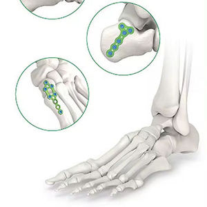 Placa de bloqueo volar para radio distal con certificación CE para el tratamiento de fracturas agudas instables, implante de fijación ósea de acero para traumatología ortopédica - Product Image 1