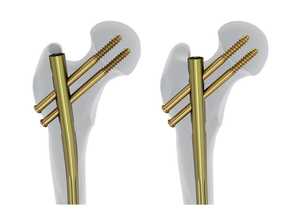 Clavo Intramedular Tibial Suprapatelar de Titanio de Grado Médico de Alto Rendimiento con Construcción Canulada - Product Image 3