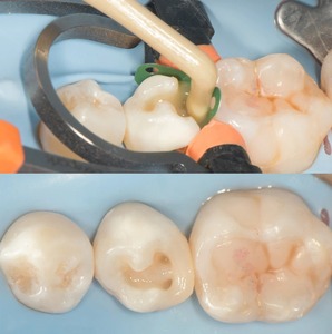Instrumento para Formar Puntos de Contacto Dentales para Composite Clase II - Product Image 5