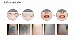 Láser ADSS RY580, máquina de eliminación de tatuajes, ND YAG q-switch - Product Image 6