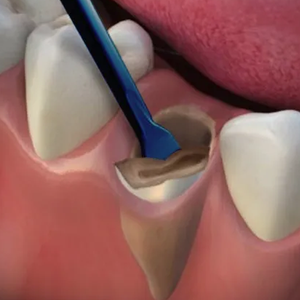 Juego de Implantes Dentales de Acero Inoxidable PDL Luxating, 8 Casetes, Elevadores Manuales Ligeros, Certificación CE Clase I, Kit Dentavex - Product Image 6