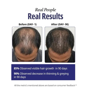 Sets de Cuidado Capilar Todo en Uno, Suero para el Cabello para Hombres, Tratamiento para el Cuero Cabelludo, Promueve el Crecimiento, Previene la Caída del Cabello, Tónico Nutritivo 30ml, Alopecia - Product Image 5