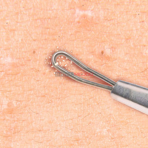 Extractor Profesional de Puntos Negros de Acero Inoxidable, Herramienta para Eliminar Granos, Acné, Espinillas y Puntos Blancos - Product Image 3