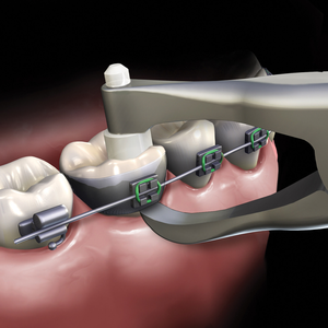 High Quality Slim Posterior Band Removing Pliers Professional Orthodontic <b>Tool</b> <b>Safe</b> Effective Dental Appliance Instrument - Product Image 1