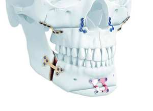 Kit d'instruments de chirurgie orthopédique et maxillo-faciale OEM comprenant des plaques et des instruments en titane médical maxillo-facial par Dentavex - Product Image 6