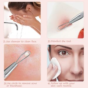 Extractor de Puntos Negros 2 en 1 de Acero Inoxidable, Herramienta Profesional para Eliminar Imperfecciones, Comedones y Espinillas, Cuidado de la Piel - Product Image 2