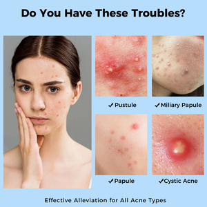 Parches para Espinillas con Microagujas, Hipoalergénicos, No Irritantes, Anti-Acné - Product Image 2