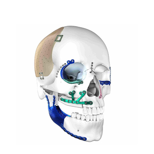 Système de fixation maxillo-faciale en maille de titane pour implant neurochirurgical, plaque de verrouillage et vis, par Mahfooz Instruments - Product Image 4
