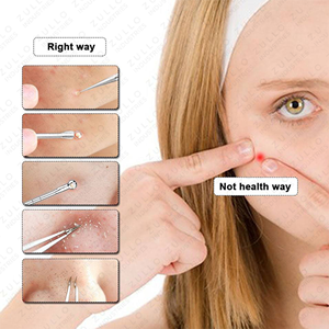 Kit de Extracción de Acné y Puntos Negros de Acero Inoxidable de 5 Piezas, Marca Privada OEM, Venta al Por Mayor, Herramientas de Extracción de Acné con Estuche - Product Image 5