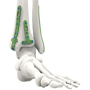 Placa de bloqueo volar para radio distal con certificación CE para el tratamiento de fracturas agudas instables, implante de fijación ósea de acero para traumatología ortopédica - Product Image 2