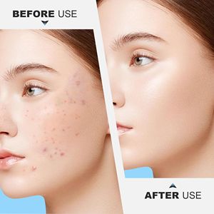 11cm High Carbon Steel Face Comedone <b>Extractor</b> <b>Tool</b> | Professional Double-Ended Acne & <b>Blackhead</b> Remover - Product Image 5