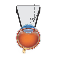 Opticlear Single Mirror Goniolens Ophthalmic Lens Manual Surgical Instrument Set Class I CE Certified