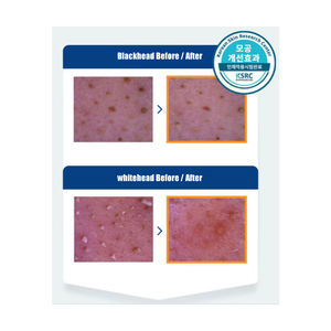 Parche Nasal Hidrocoloide Hecho en Corea para Eliminar Puntos Negros y Limpiar los Poros - Tira Nasal Invisible para Control de Sebo OEM/ODM - Product Image 3