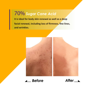 Sucre de canne à base de plantes acide Peel 70% sérum pour visage corps blanchissant la peau rajeunissant Anti-âge accélère pour la peau noire produit - Product Image 3