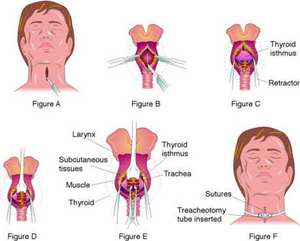 Instrumentos de traqueomy, tubo de chevalier jackson, traqueomy de acero inoxidable - Product Image 4