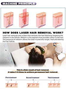 Máquina de Depilación Láser Diodo de Última Generación, 3 Longitudes de Onda 808/755/1064, Indolora - Product Image 5