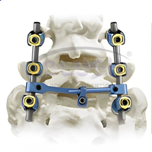 Precio de fábrica: Juego de instrumentos quirúrgicos espinales de acero inoxidable de alta calidad con tornillo pedicular manual de 5.5 mm para Pakistán - Product Image 1