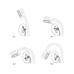 Pinze Chirurgiche <span class=keywords><strong>Ruya</strong></span> Randall per Calcoli Renali in Acciaio Inossidabile, Curve 225mm, Angolate 190mm, Strumento Chirurgico Urologico Riutilizzabile - Product Image 6