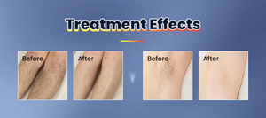 Épilation au laser à impulsions longues ADSS ND:YAG 1064 nm pour toutes les couleurs de peau Modèle : LP2016 - Product Image 6