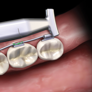 Pince à marteau fin en NiTi, outil orthodontique professionnel, instrument dentaire sûr et efficace, de haute qualité et durable - Product Image 2